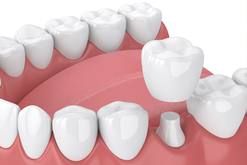 Dental Crowns in Middletown