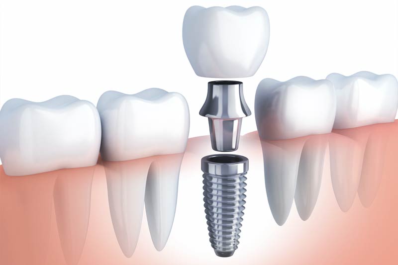 Dental Implants in Middletown
