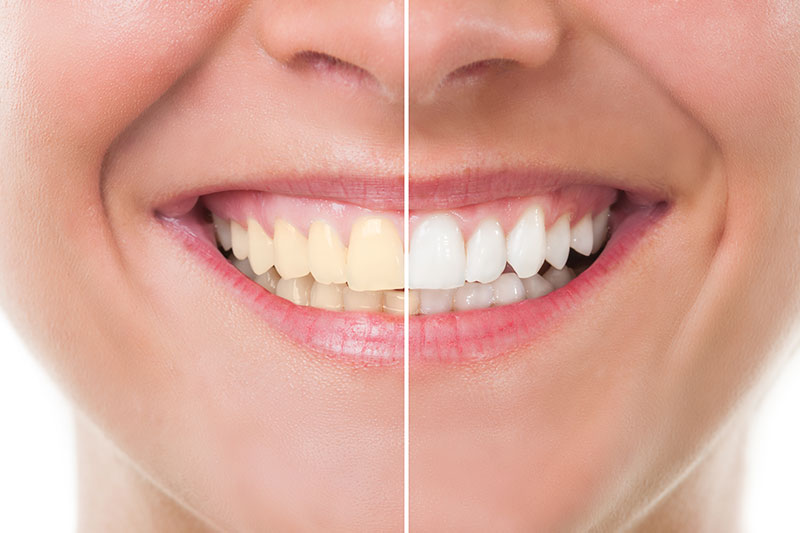 Teeth Whitening in Middletown