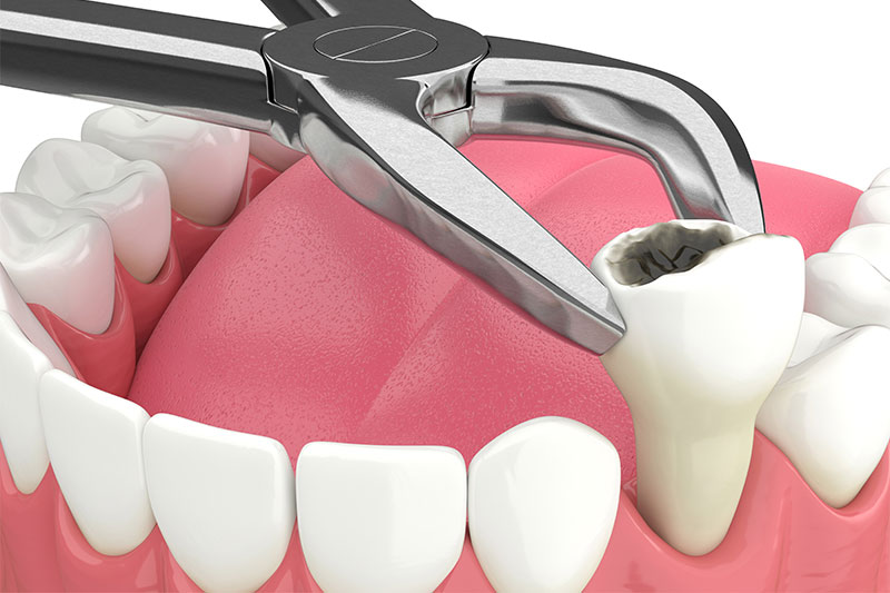 Tooth Extractions in Middletown