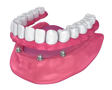 graphic of implant retained dentures middletown