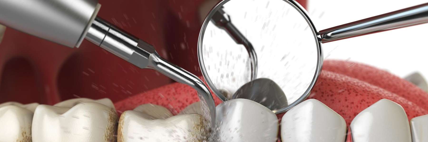dentist middletown | teeth cleaning
