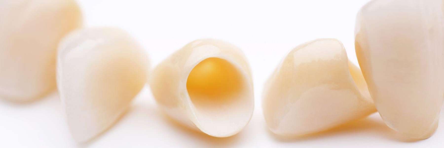 Tooth with a cavity, illustrating the initial stage of the dental crown procedure.