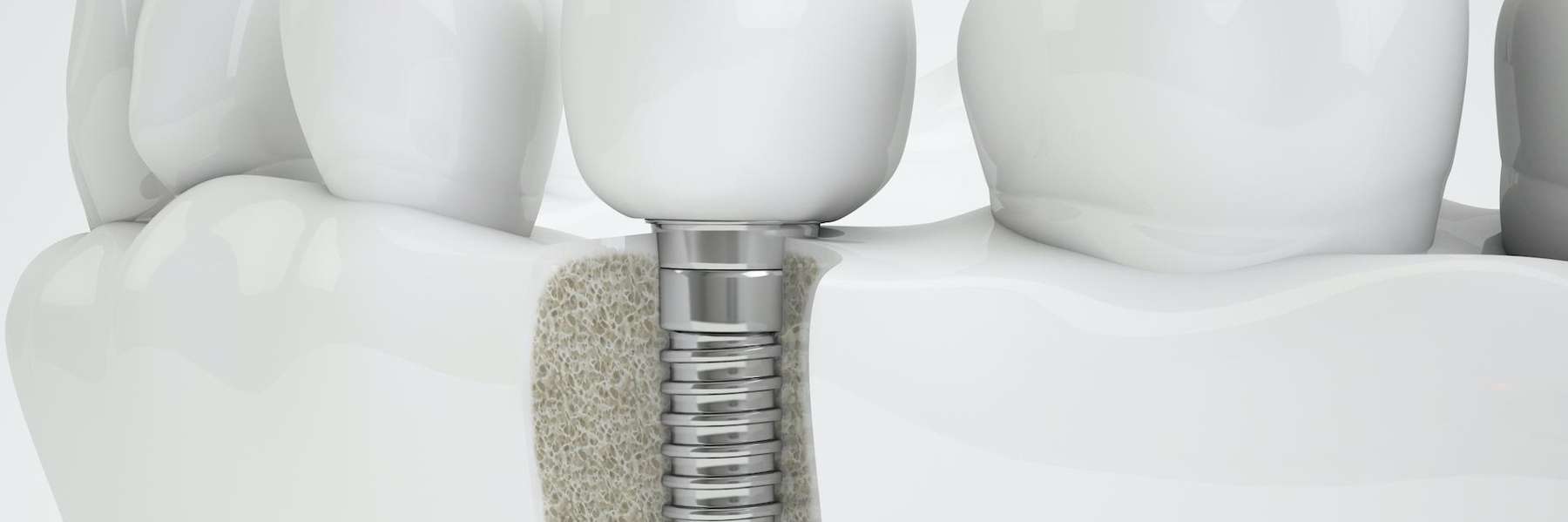 dental implants middletown