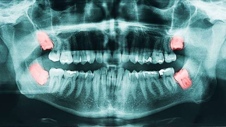 X-ray picture of patients teeth at Middletown Dental