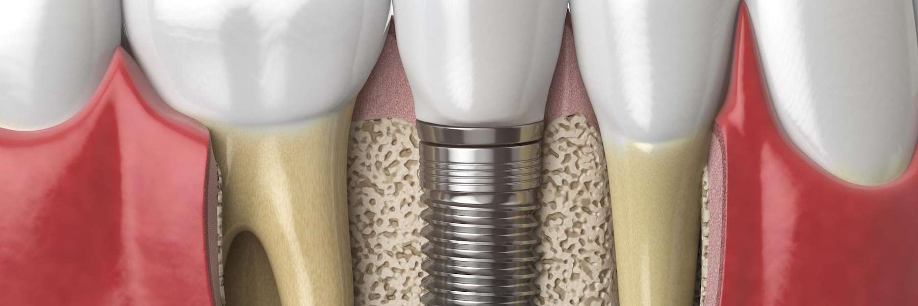 dental implants middletown